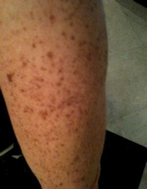 Brown Spots on Legs – Causes, How to Get Rid of Dark Spots, Remove ...