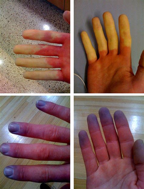 Raynaud Phenomenon Symptoms, Causes, Diagnosis, Treatment | Healthhype.com