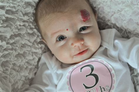 Infant Hemangioma Pictures – 54 Photos & Images / illnessee.com