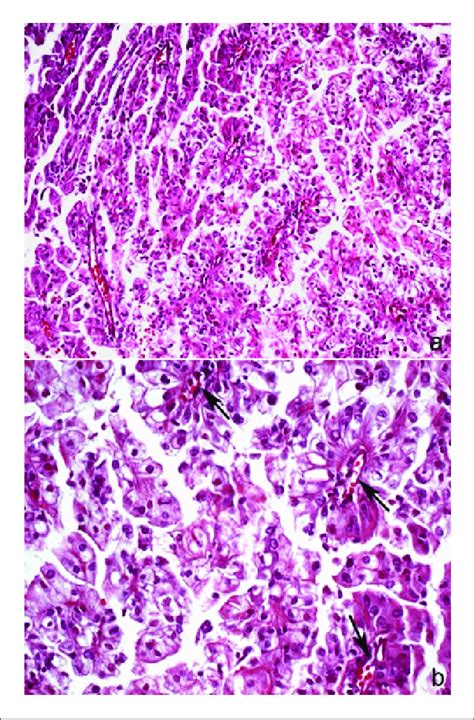 Histology of renal carcinoma. a) Epithelial neoplasm showing diffuse ...