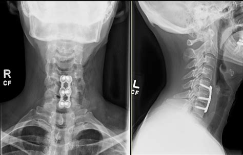 ACDF - Joshua Li, MD, PhD