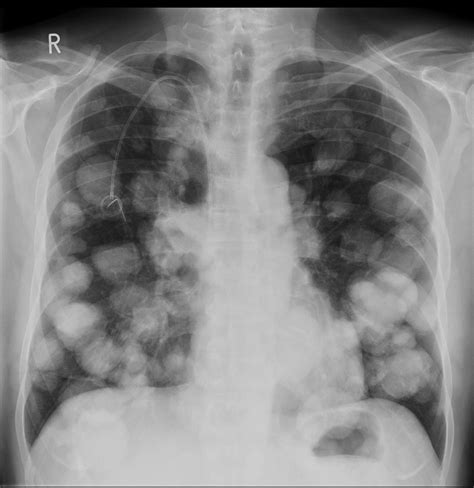 Cannonball metastases - colorectal cancer - Radiology at St. Vincent's ...