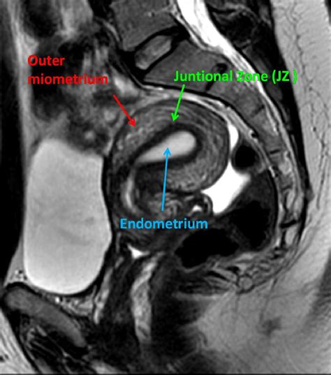 Uterus Anatomy Mri