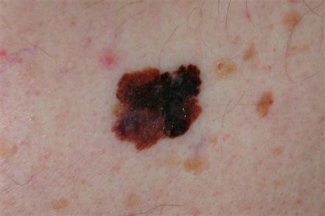 Seborrheic Keratosis - Causes, Symptoms, Home Treatment