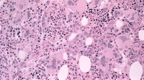 Fast Five Quiz: Prognosis of Primary Myelofibrosis