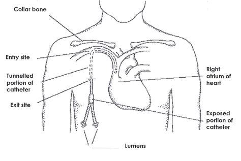 Hickman Catheter Removal