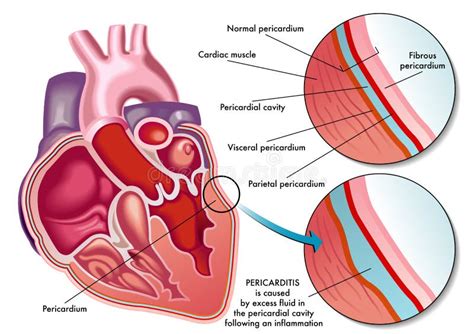 Pericarditis Stock Vector - Image: 59765397