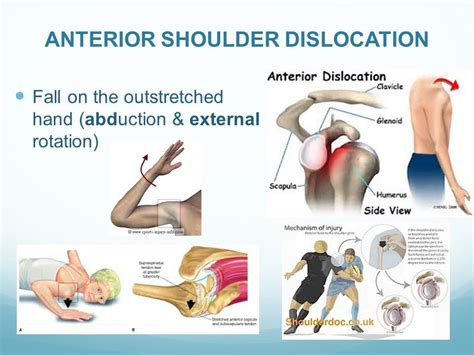 Anterior Versus Posterior Shoulder Dislocation