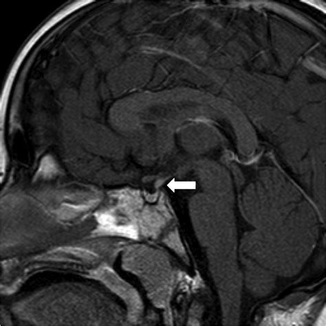 Pituitary and Hypothalamic Tumor Syndromes in Childhood - Endotext ...