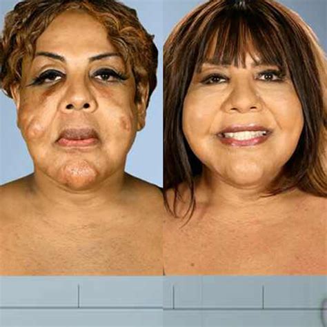 Photos from Botched Patients Before and After: Shocking Transformations!