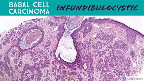 Superficial Basal Cell Carcinoma Histology