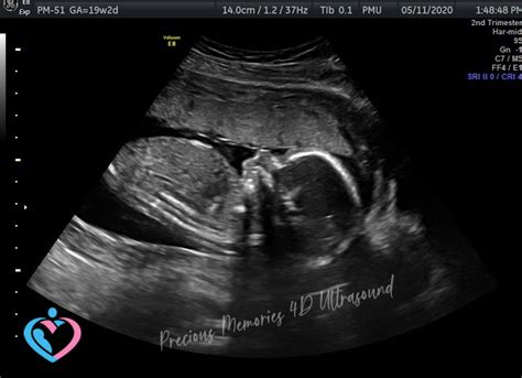 Pregnancy Ultrasound Image Gallery - 10 - 16 Weeks