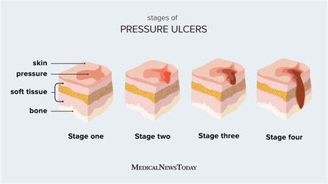 Stages of pressure ulcers: Treatment and recovery