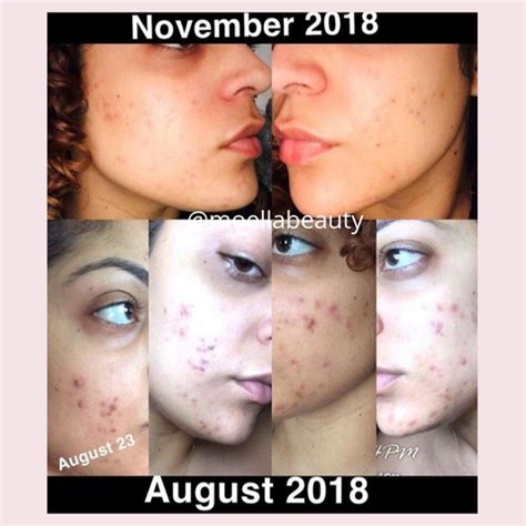 before and after acne new skin who dis