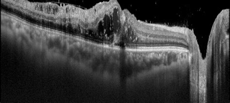 Macular Edema Oct