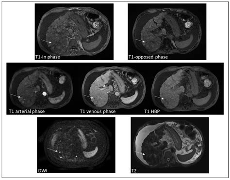 Diagnostics | Free Full-Text | MRI Appearance of Focal Lesions in Liver Iron Overload