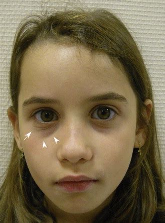 Dennie-Morgan Fold Plus Dark Circles: Suspect Atopy at First Sight - The Journal of Pediatrics