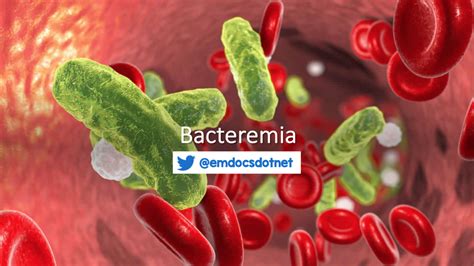 emDOCs.net – Emergency Medicine EducationBacteremia: ED Presentations, Evaluation, and ...