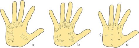 Dermatoglyphics definition, uses, causes of abnormal dermatoglyphics