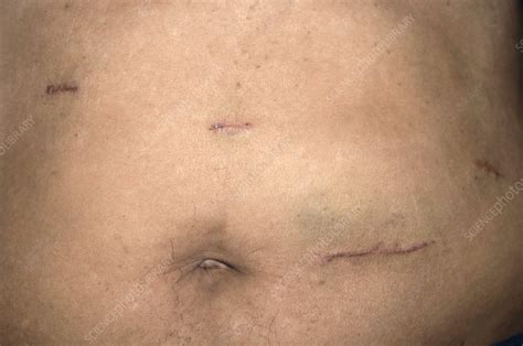 Abdominal scars after stomach surgery - Stock Image - M332/0194 ...