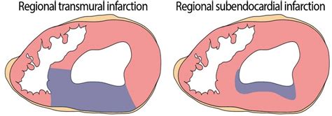 Acute Coronary Syndrome (ACS) - Clinician Revision