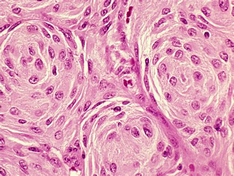 Meningioma: solitary, slow-growing, surgery works. | Pathology Student