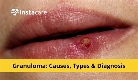 What Is Granuloma - Causes,Types, Diagnosis And Treatment