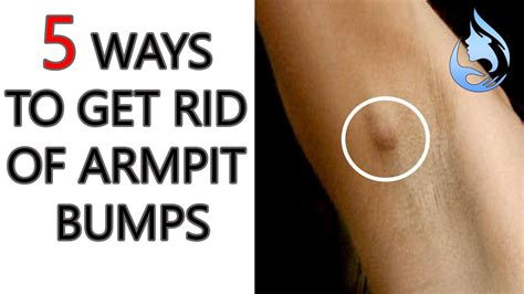 5 WAYS TO GET RID OF ARMPIT BUMPS - YouTube