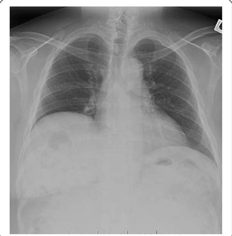 Chest X-ray showed stable mild elevation of the right hemidiaphragm.... | Download Scientific ...