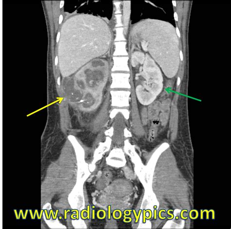 Xanthogranulomatous Pyelonephritis | RADIOLOGYPICS.COM