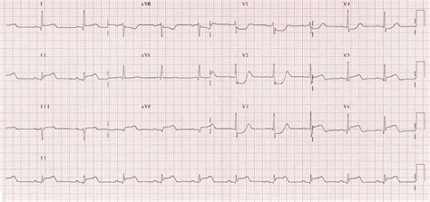 Lateral STEMI ECG changes • LITFL • ECG Library Diagnosis