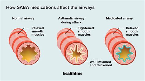 SABA Medications for Asthma: Benefits, Side Effects, and More