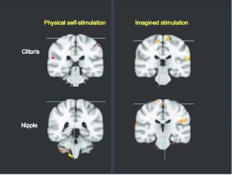 Paracentral lobule 'genital sensory' cortical activations in physical ...