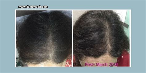 PRP For Hair Loss – Before And After | Dr. Marwah’s Clinic