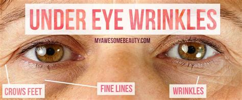 How to get rid of under eye wrinkles fast and safely