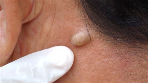 Why You Should Never Pop A Sebaceous Cyst At Home