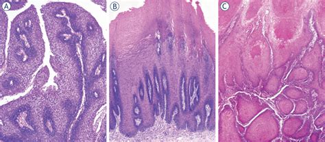 Histopathology images of oral verrucous lesions. Squamous cell... | Download Scientific Diagram