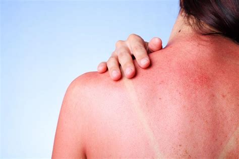 Bad Sunburn? Learn About These Home Remedies to Soothe Your Skin: So Cal Body Institute: Medical Spa