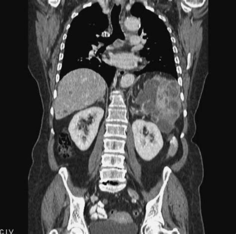 aerolíneas Observar período tac abdomen y pelvis sol Sabroso cerveza negra