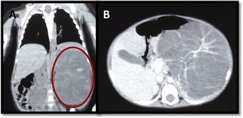 Computerised tomography scan of the abdomen showing features presumed... | Download Scientific ...