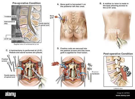 Spondylolisthesis l5 s1 hi-res stock photography and images - Alamy