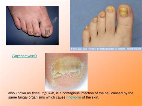 PPT - The most commonly reported nail conditions, seen by podiatrists, are: Onychocryptosis, 26% ...