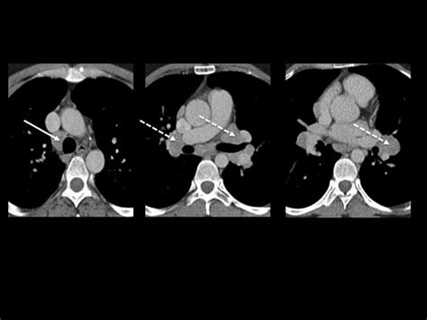 Hilar and mediastinal adenopathy in a 35-year-old woman. CECT clearly... | Download Scientific ...