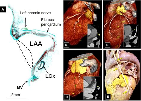 Left atrial appendage: anatomy and imaging landmarks pertinent to percutaneous transcatheter ...