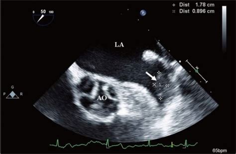 Image of thrombus (arrow) within the left atrial append | Open-i