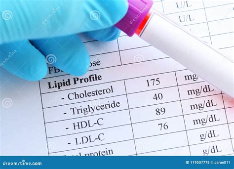 Lipid Profile Testing Stock Photography | CartoonDealer.com #56094824