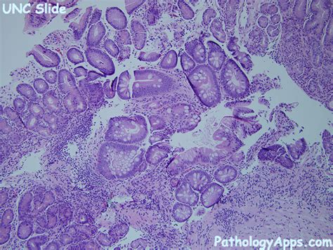 intestinal metaplasia pathology