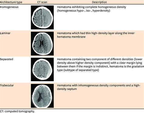 Type of chronic subdural hematoma on computed tomography by internal... | Download Scientific ...