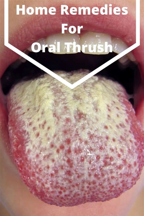 Top 12 Home Remedies for Oral Thrush - How to Get Rid of Oral Thrush?