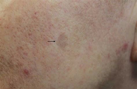 Lichenoid keratosis causes, symptoms, diagnosis & treatment